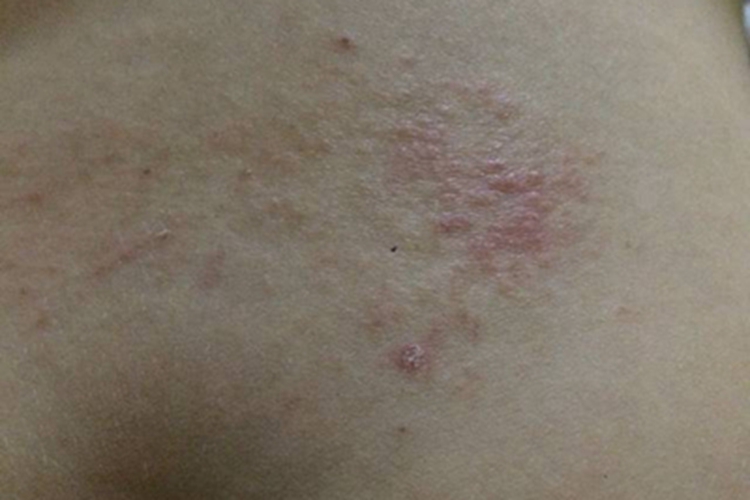 亚急性湿疹腰部图