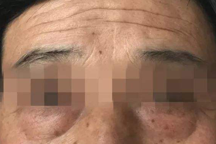 肾功能不好导致眼睑水肿图