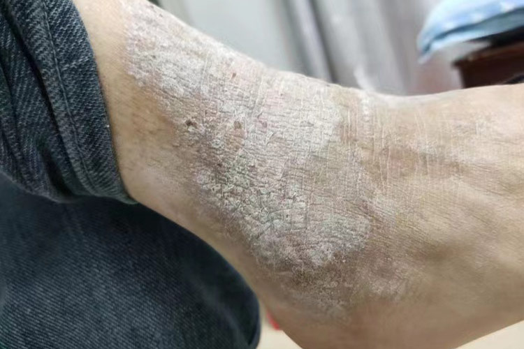 慢性湿疹图 慢性湿疹图