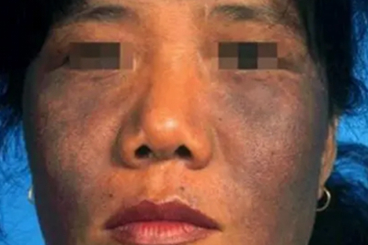 意外粉粒沉着病面部有灰蓝色斑图