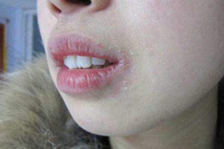 缺铁性贫血口周脱屑图