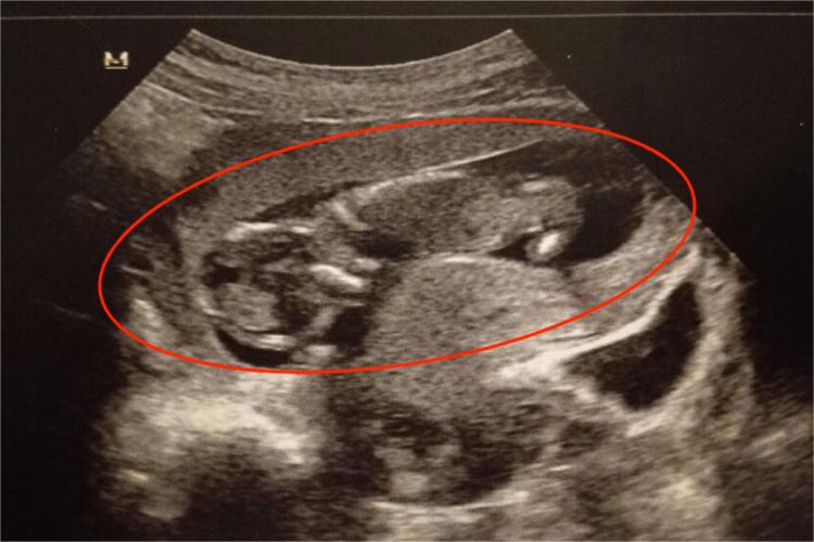 胎儿在子宫趴着图