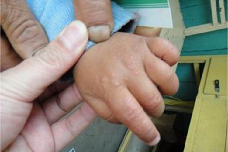 小儿丘疹性肢端皮炎丘疹图