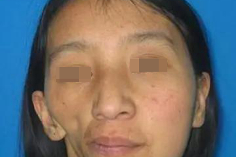 吉兰-巴雷综合征下巴萎缩图