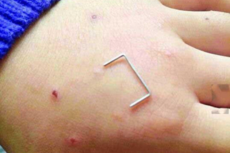 戳伤手背伤口凸起结痂图