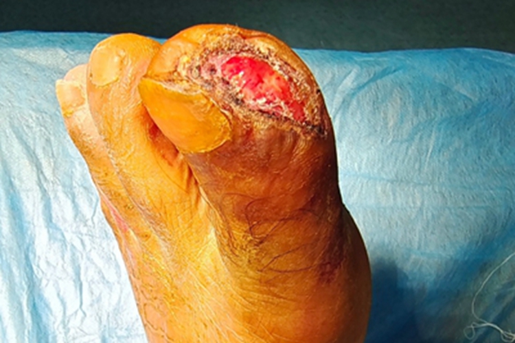 电烧伤皮肤坑图