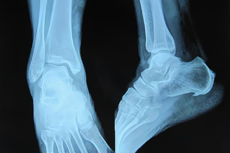 跟骨骨质增生X线片图