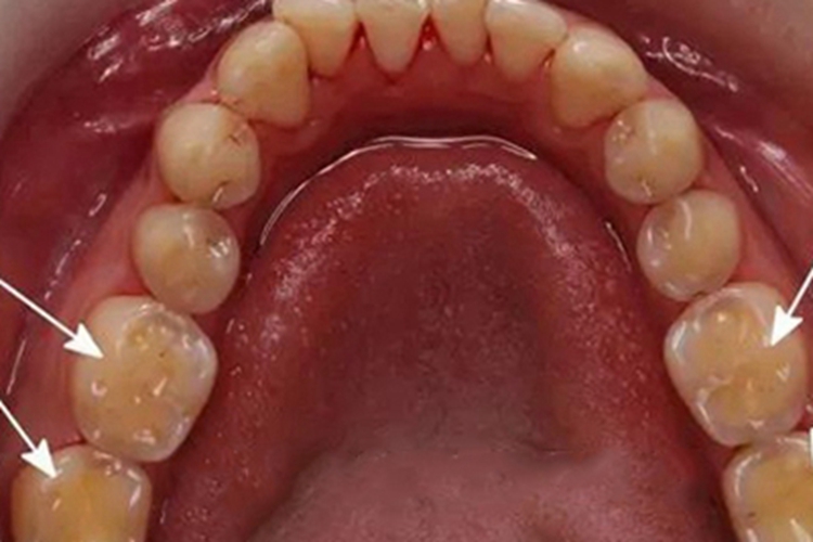 酸蚀症牙齿缺损有坑图