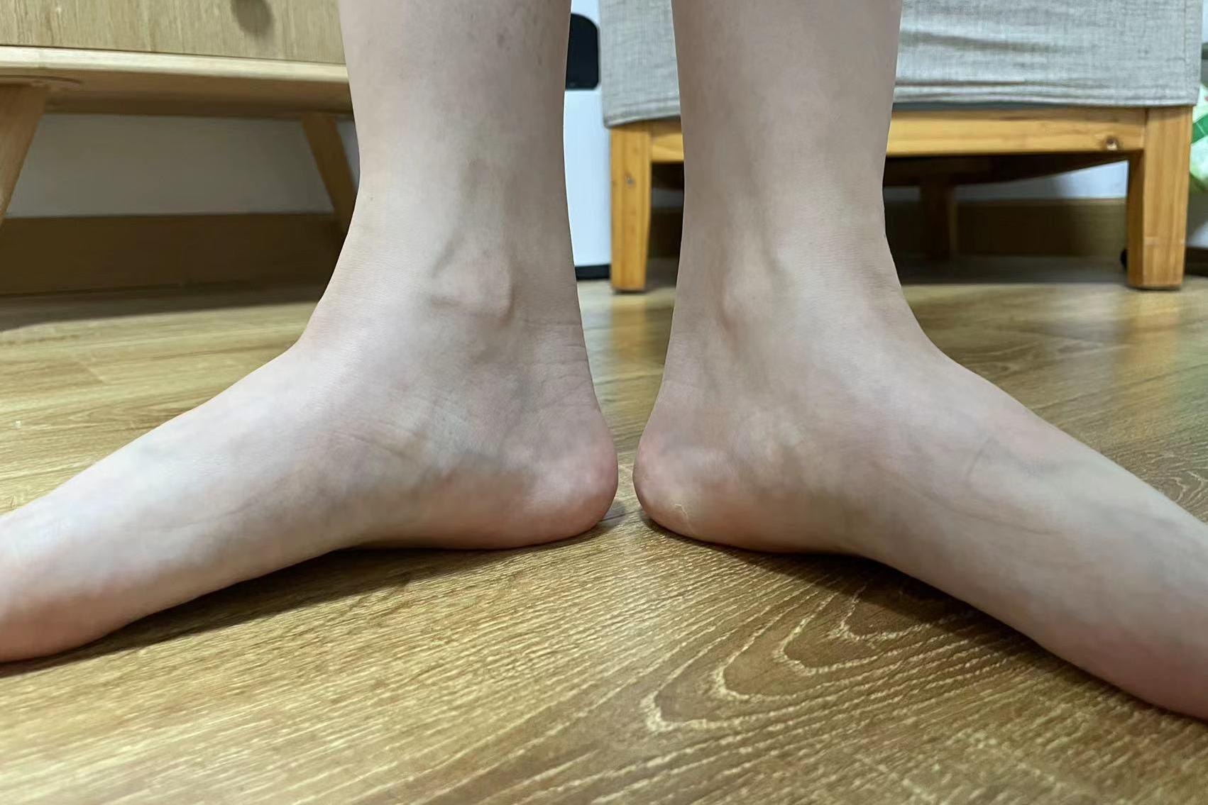 扁平足矫正后图 扁平足矫正后图