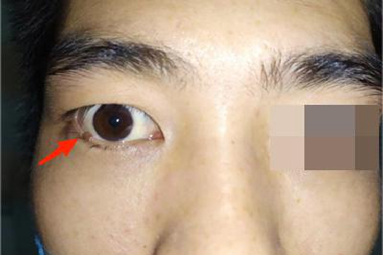 皮内痣眼睑痣图
