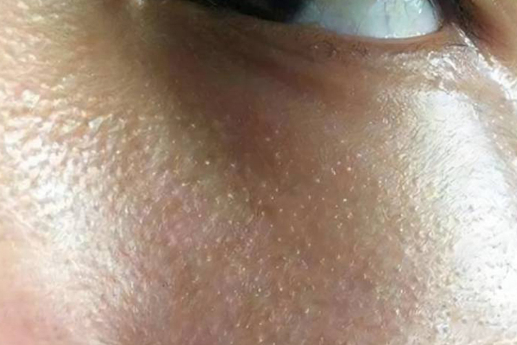 眼下毛周角化图