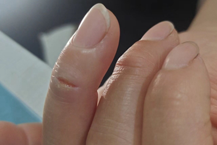 Ⅲ度皮肤皲裂症状图