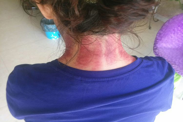 痧象呈鲜红色图