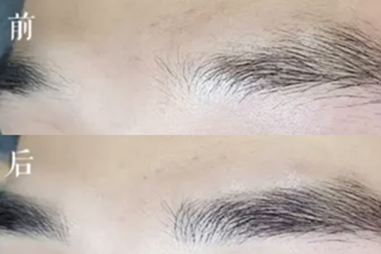 植眉前后对比图 植眉前后对比图