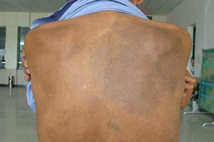 摩擦黑变病症状图 摩擦黑变病症状图