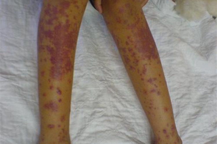 机械性紫癜双腿紫红斑图