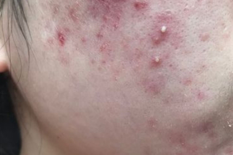 严重痤疮脓肿粉刺图