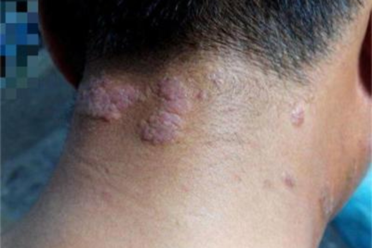 局限性神经性皮炎后颈小疙瘩图