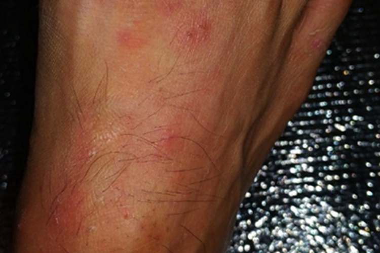 蚁蜇伤脚上有红斑结痂图 蚁蜇伤脚上有红斑结痂图