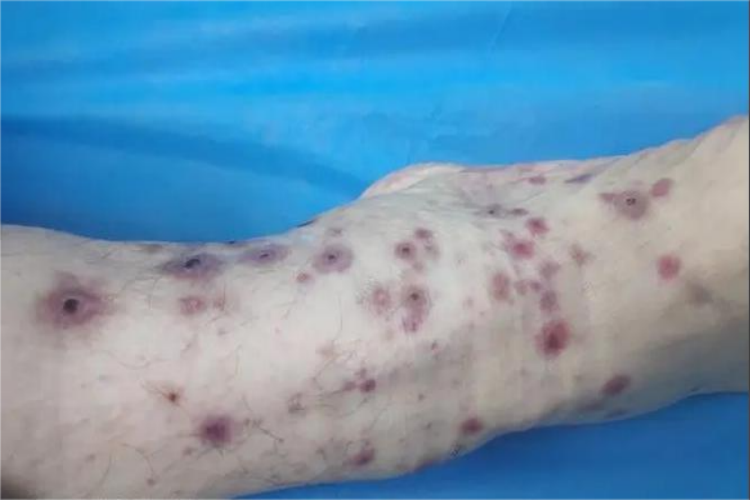 变应性皮肤血管炎皮损图