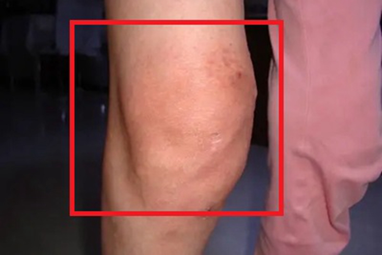 风湿性关节炎症状图