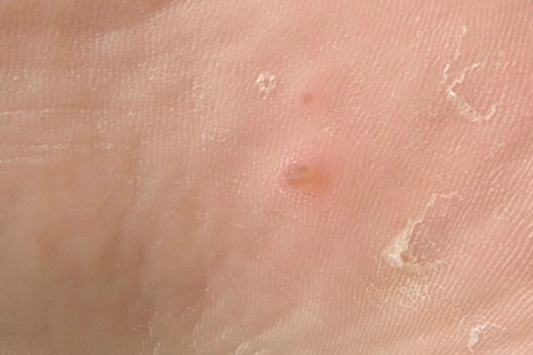 寻常疣脚底有黄色丘疹图 寻常疣脚底有黄色丘疹图