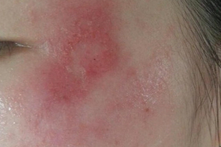 镜架皮炎颞部大片发红图 镜架皮炎颞部大片发红图