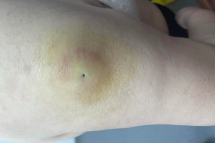 皮脂腺囊肿胳膊结节图