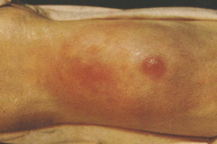 性病性淋巴肉芽肿早期症状图 性病性淋巴肉芽肿早期症状图