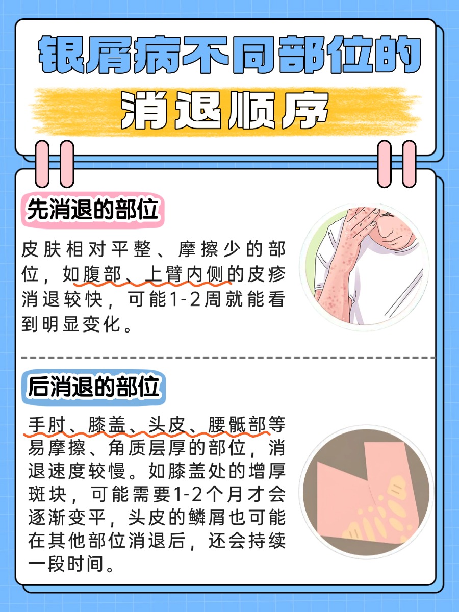 银屑病消退顺序，医生教你正确判断！