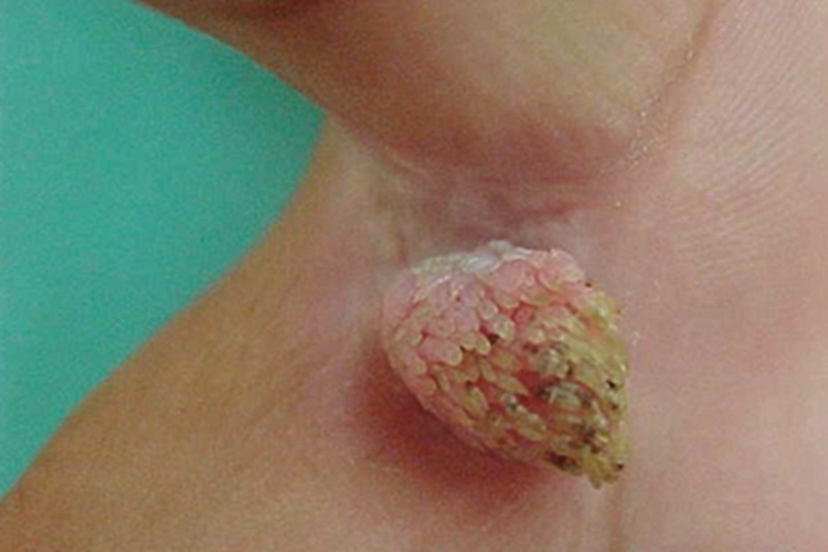 职业性疣赘手指缝症状图