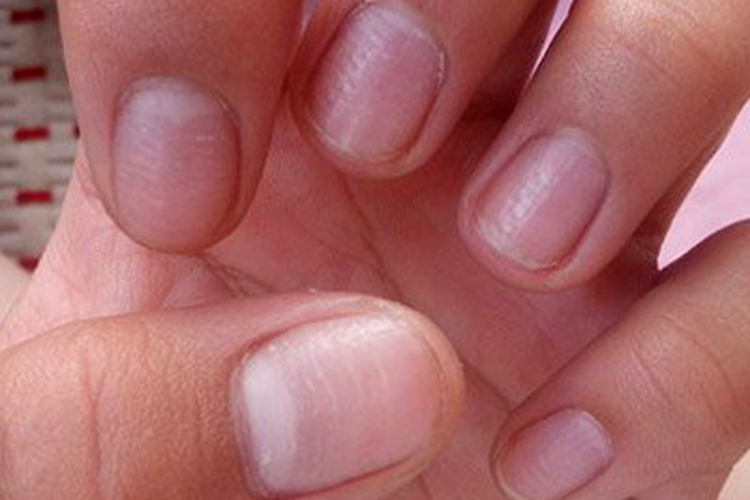营养缺乏导致手指甲波浪纹图