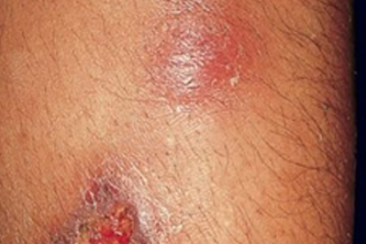 硬红斑小腿肿块图