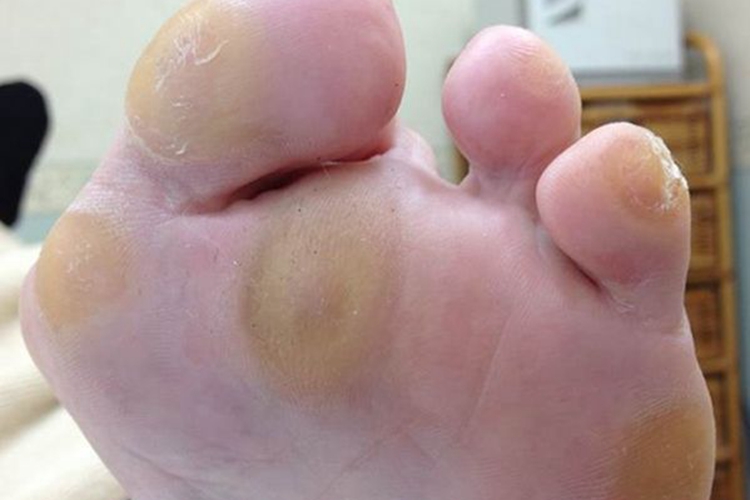 胼胝脚底发黄图