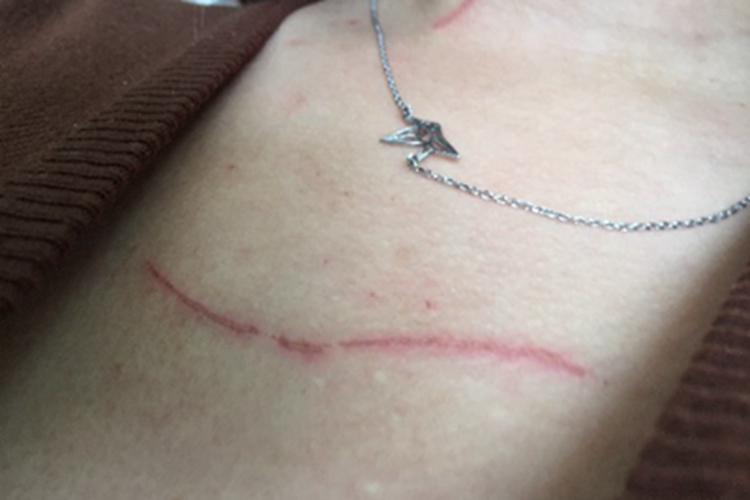 抓伤胸部细线样的红肿图