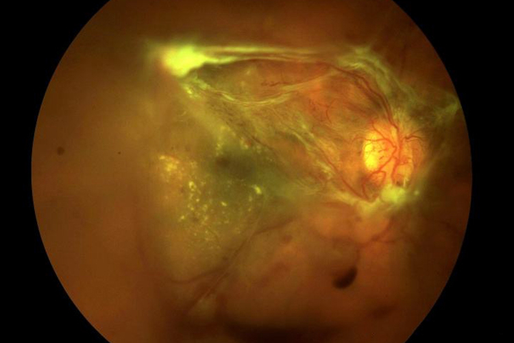 牵拉性视网膜脱离图