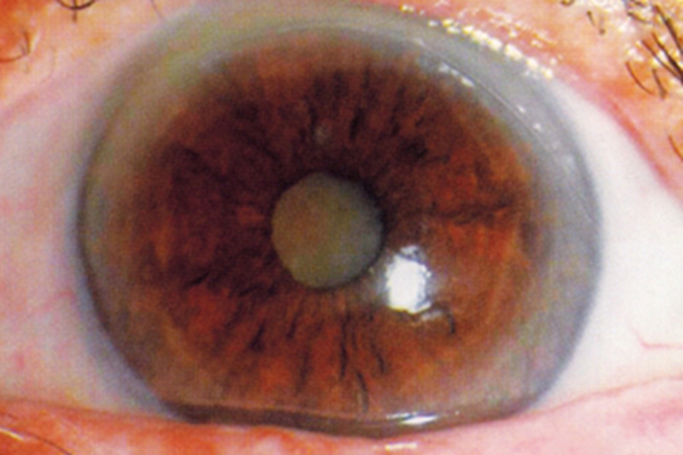 老年性白内障混浊图