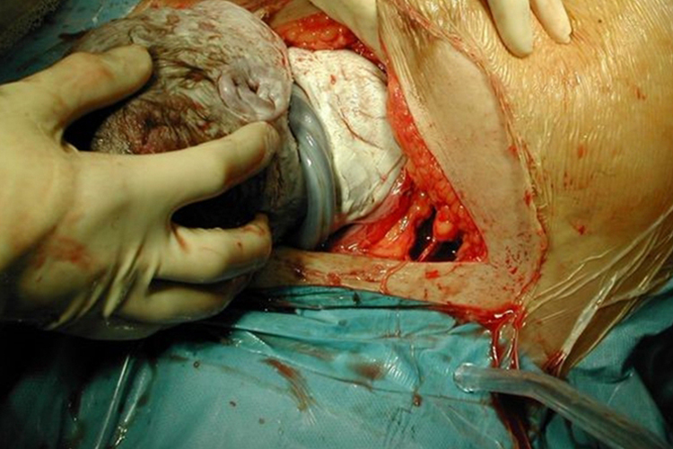 脐带绕颈图 脐带绕颈图