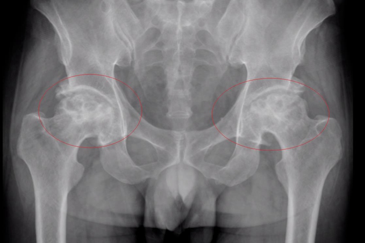 股骨头坏死X片严重塌陷图