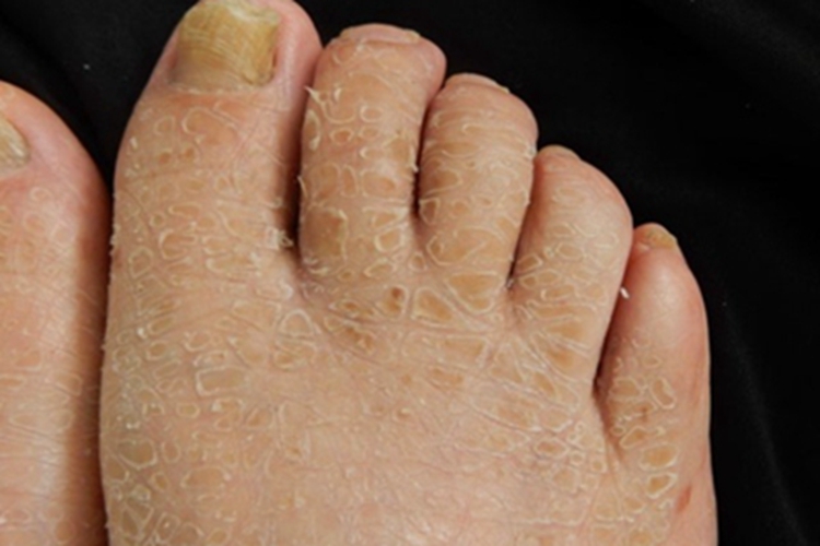 板层状鱼鳞病脱屑图