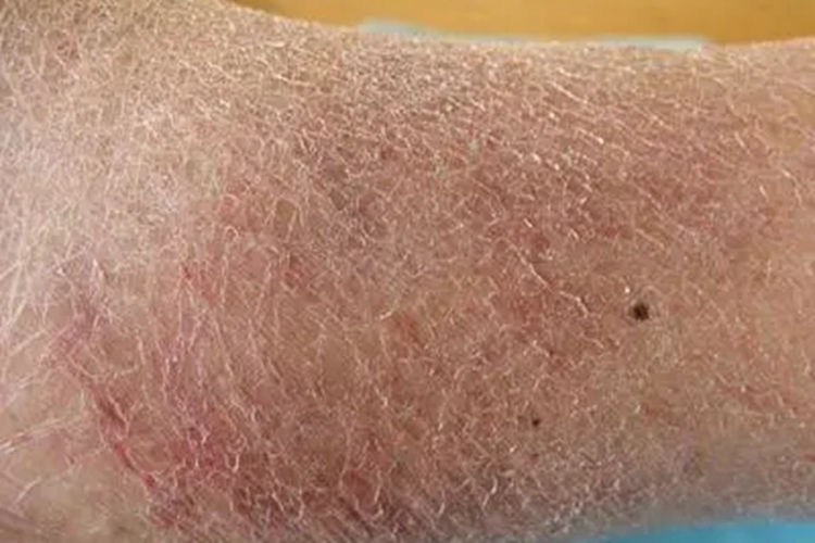 全身性瘙痒症脚踝皮肤粗糙图