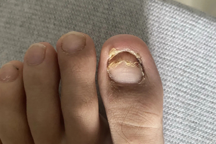 拔甲后指甲完全覆盖甲面图