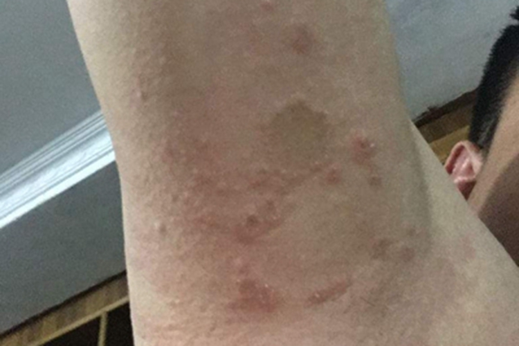 特应性皮炎腋窝红斑图 特应性皮炎腋窝红斑图