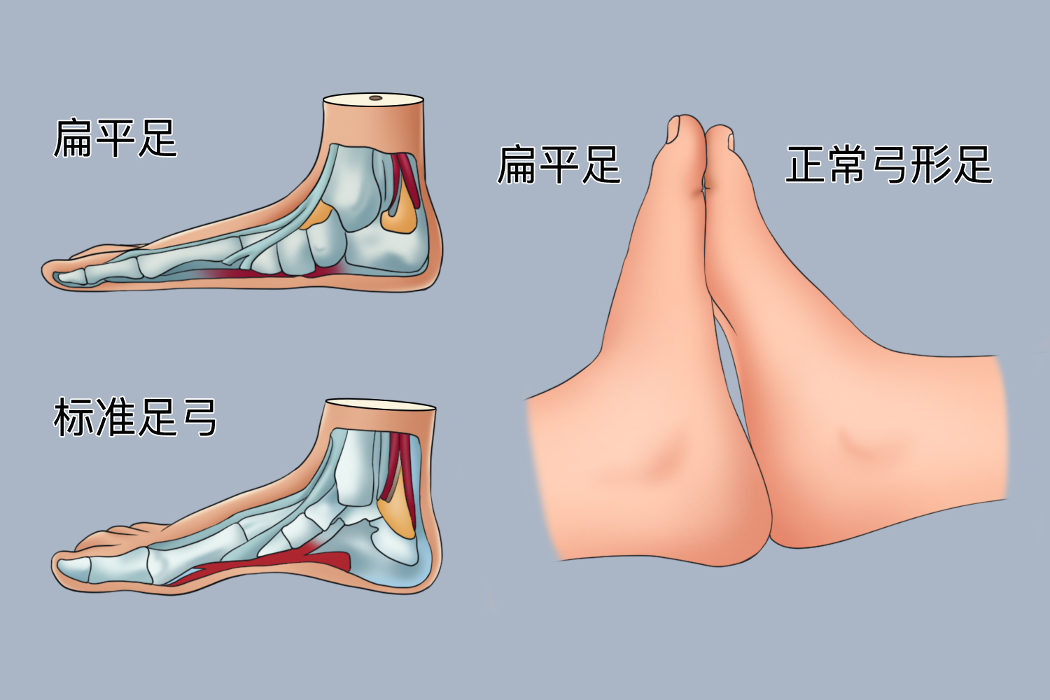 正常人足弓与扁平足患者足弓对比图