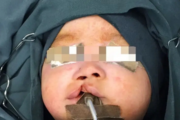 18-三体综合征唇腭裂图