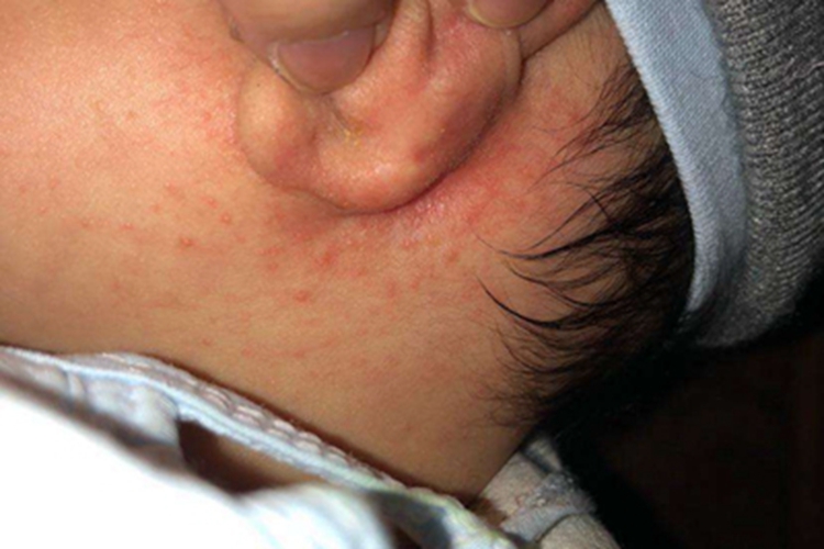 渗出型婴儿湿疹耳后丘疹图