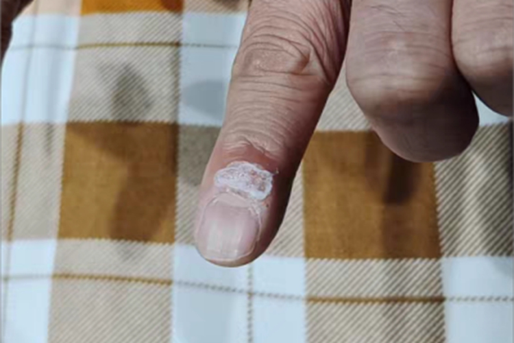 寻常疣手指白斑图