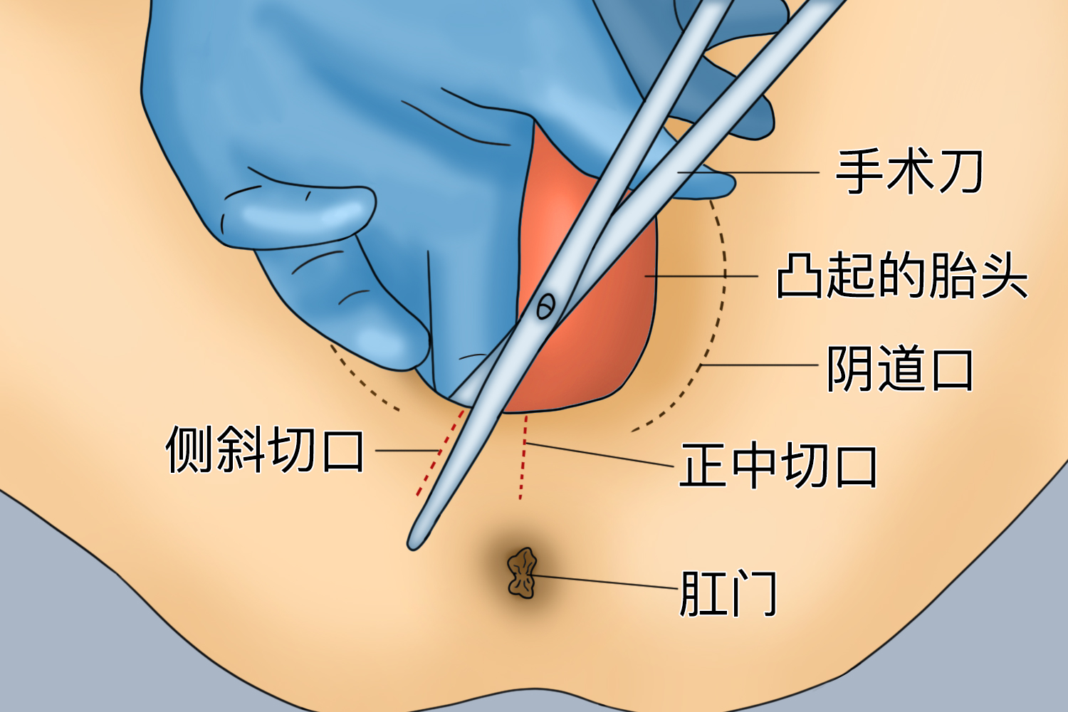 侧切伤口图