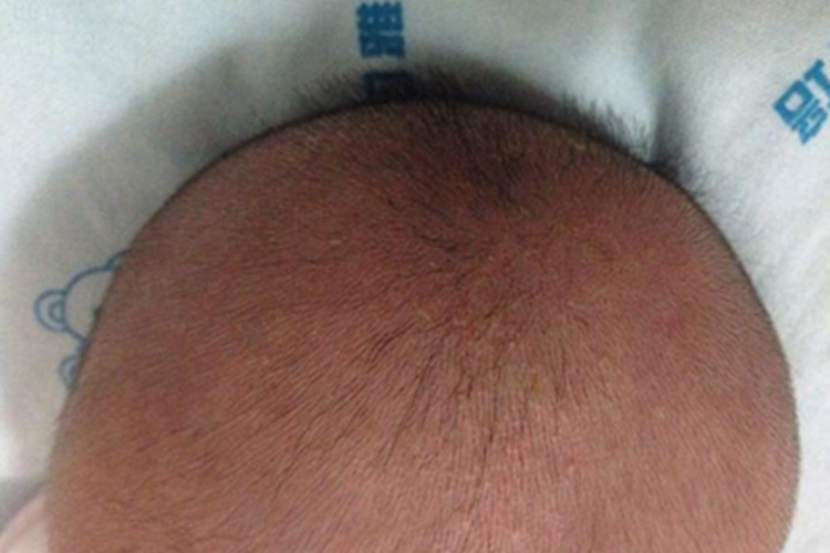 小儿生长激素缺乏症头发症状图