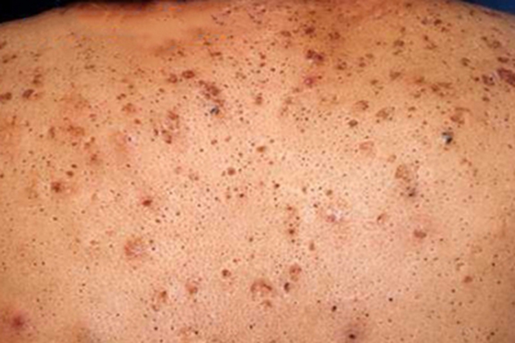 黑头粉刺样痣背部丘疹图